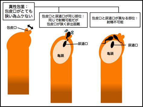 ほうけいリング おすすめ|【泌尿器科の医師が解説】包茎は手術ナシで矯正でき。